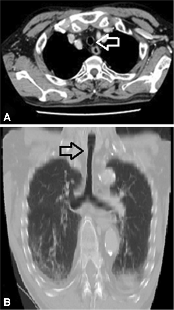 A case of asymptomatic complete tracheal rings in an adult: case report |  JA Clinical Reports | Full Text