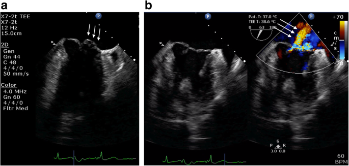 Additional cleft mitral valve diagnosed by a combination of 2-D and 3-D  echocardiography using transesophageal echocardiography during mitral valve  prolapse: a case report | JA Clinical Reports | Full Text