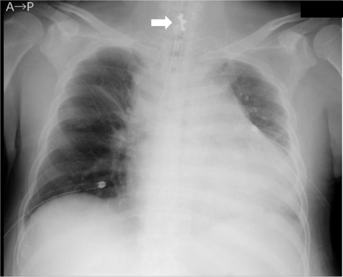 An experience of subglottic airway foreign body removal in a patient under  tracheal intubation: a case report | JA Clinical Reports | Full Text