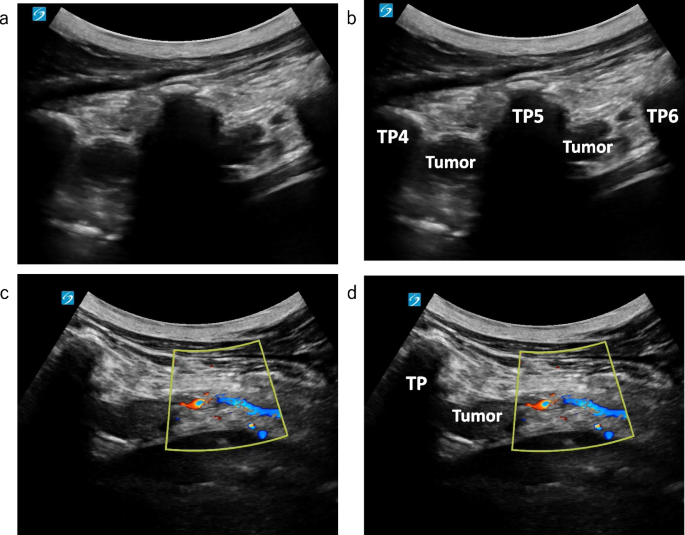 What is safe paravertebral block and neuraxial anesthesia for patients ...
