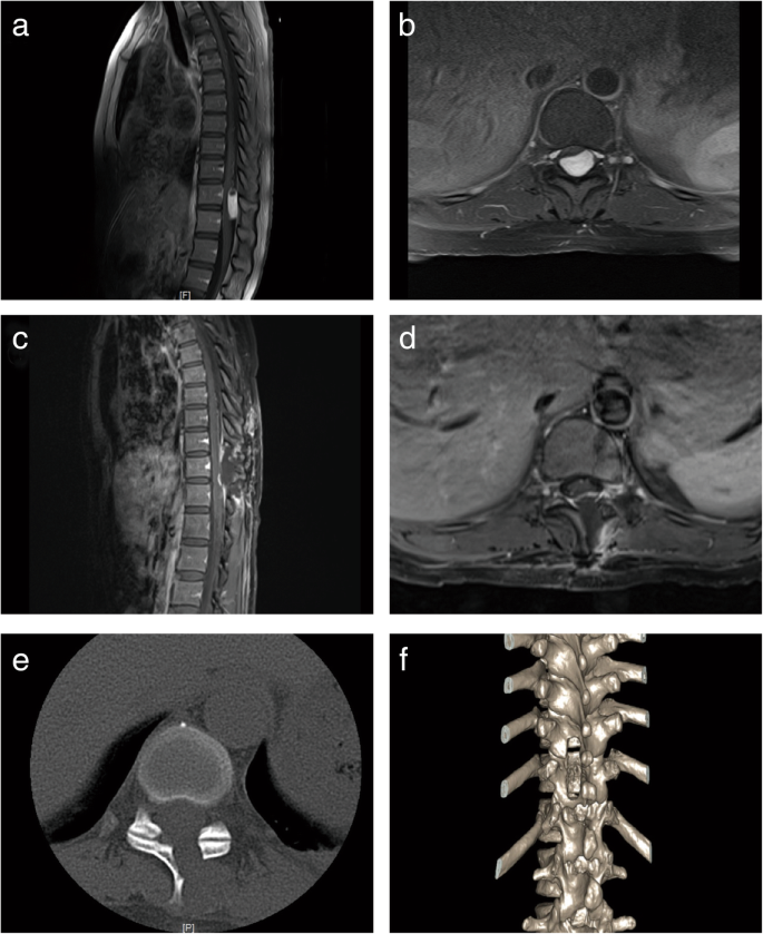 Endoscopically Controlled Surgery With Open Hemilaminectomy For The Treatment Of Intradural Extramedullary Tumors An Operative Technique And Short Term Outcomes Of 20 Consecutive Cases Chinese Neurosurgical Journal Full Text