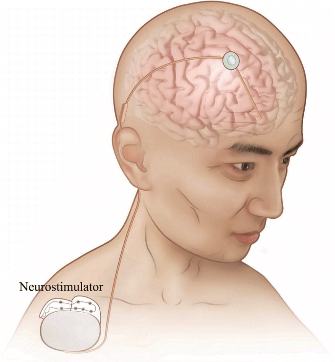 Deep-Brain Stimulation for Parkinson's Disease