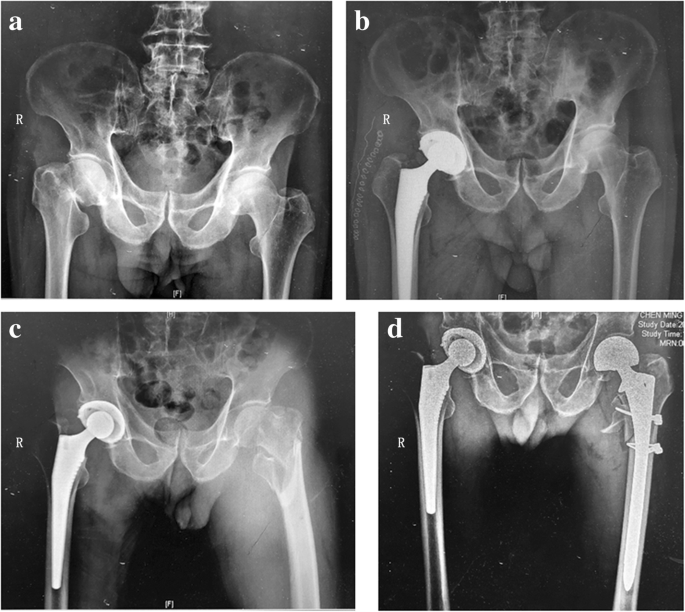 elderly broken hip recovery time