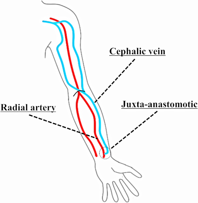 brachial cephalic fistula