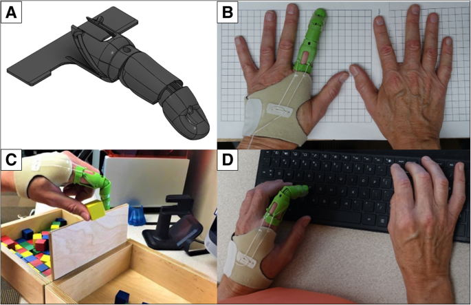 Assessment of body-powered 3D printed partial finger prostheses: a case  study, 3D Printing in Medicine