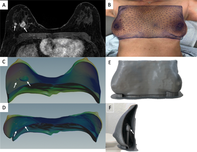 Applications of 3D printing in breast cancer management | 3D Printing in | Full Text