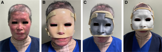 Digital workflow for fabrication of bespoke facemask in burn rehabilitation  with smartphone 3D scanner and desktop 3D printing: clinical case study |  3D Printing in Medicine | Full Text