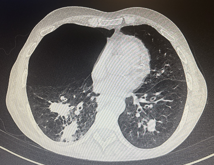 Invasive pulmonary aspergillosis in the ICU: the corticosteroid link ...