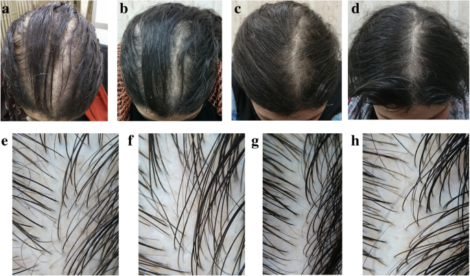 Trichogenic effect of topical ketoconazole versus minoxidil 2% in female  pattern hair loss: a clinical and trichoscopic evaluation | Biomedical  Dermatology | Full Text