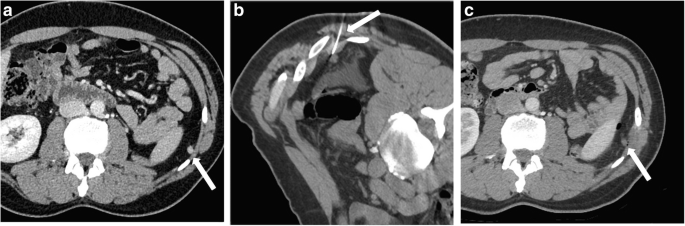 Image-guided laser ablation in the treatment of recurrence of renal  tumours: technique and preliminary results | European Radiology  Experimental | Full Text