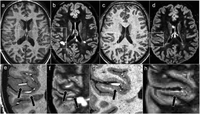 Ultra-high-field 7-T MRI in multiple sclerosis and other demyelinating  diseases: from pathology to clinical practice | European Radiology  Experimental | Full Text