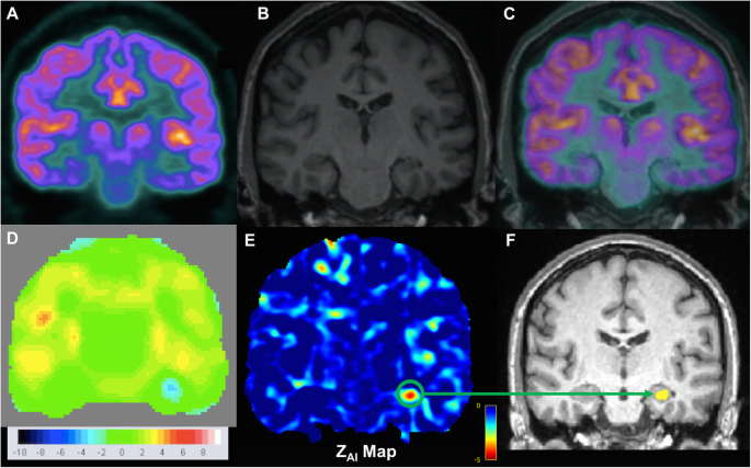 brain pet scan epilepsy