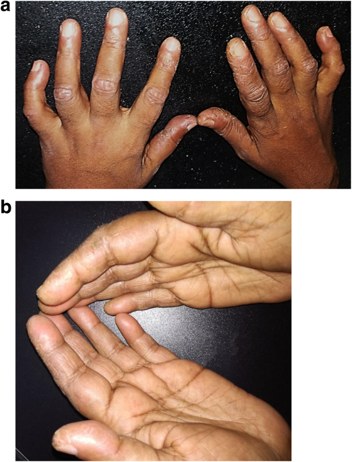 Mechanic's hand; is it a prodromic sign of disease relapse of anti-synthetase  syndrome; a case report | BMC Rheumatology | Full Text