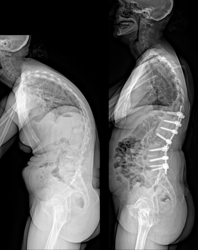 Spine surgery
