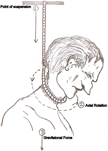 Sub-occipital ligature knot in a case of long drop suicidal ...