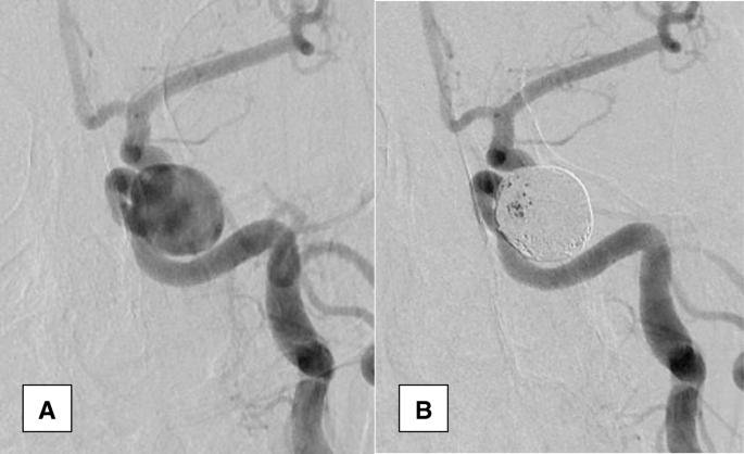 how long does aneurysm coiling last