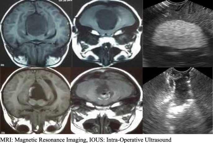 The role of intraoperative ultrasound in gross total resection of brain  mass lesions and outcome | The Egyptian Journal of Neurology, Psychiatry  and Neurosurgery | Full Text