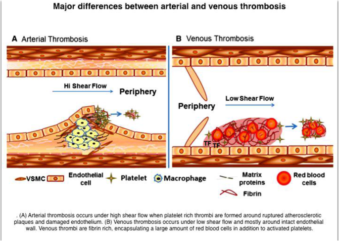 Elevated factor VIII levels and arterial stroke: a review of literature  with a case report | The Egyptian Journal of Neurology, Psychiatry and  Neurosurgery | Full Text