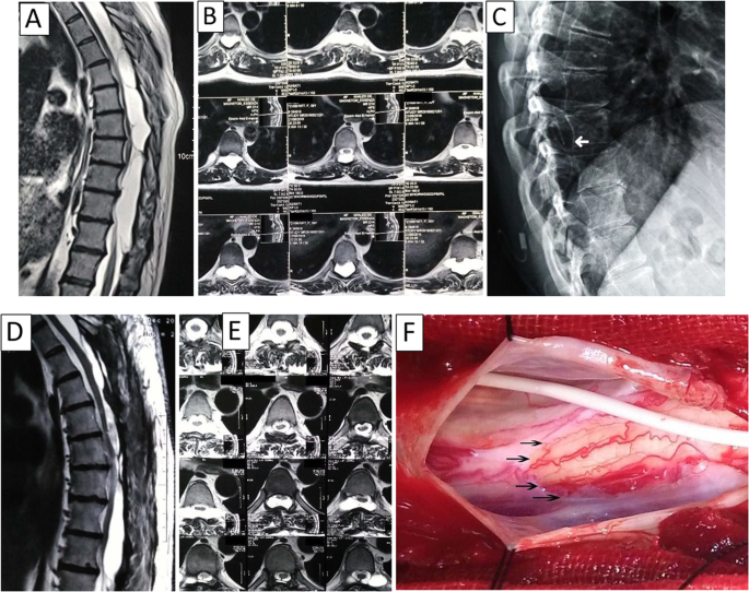 Surgical outcome of primary intradural spinal arachnoid cysts: a series of  10 cases | The Egyptian Journal of Neurology, Psychiatry and Neurosurgery |  Full Text