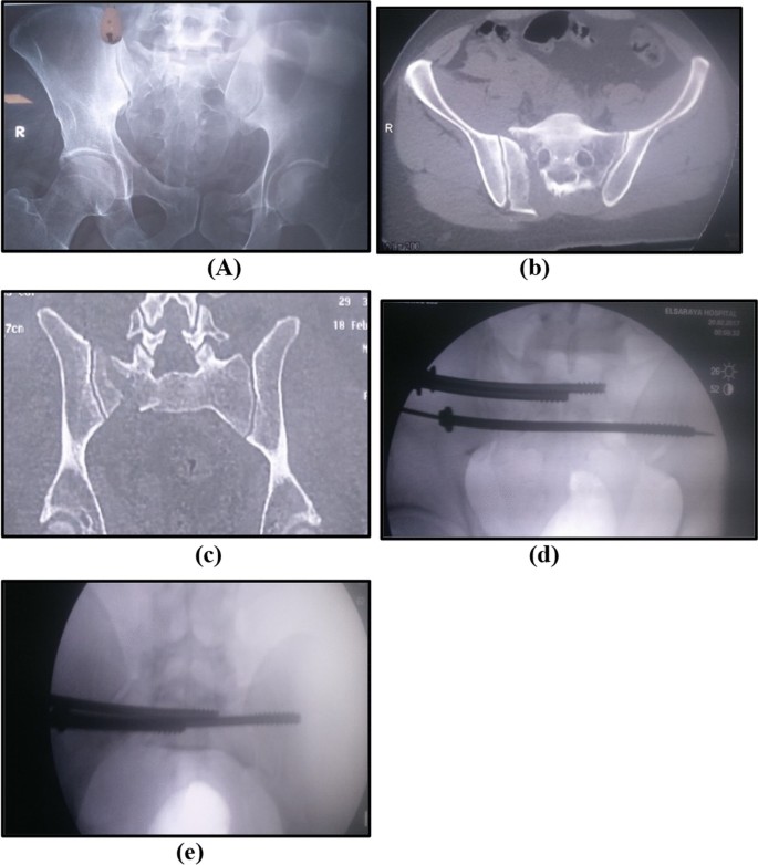 A minimally invasive surgical technique for the management of U-shape  sacral fractures | Spinal Cord Series and Cases