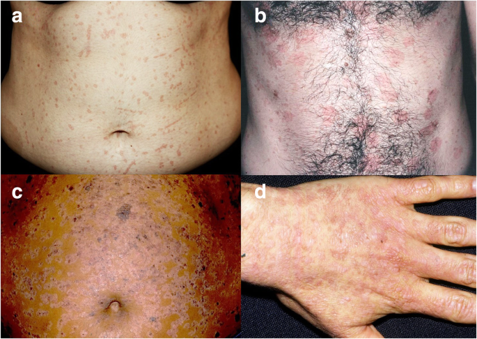 human papillomavirus skin lesions)
