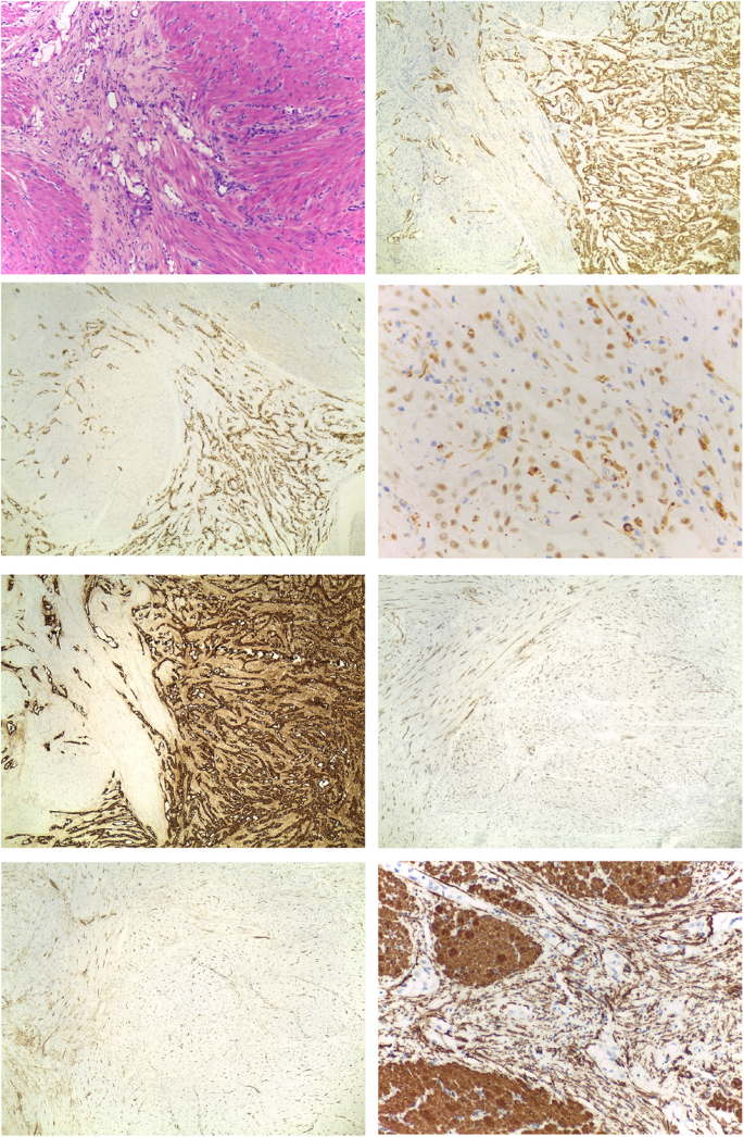 Leiomyoadenomatoid Tumor Of Uterus Two Case Reports With Literature Review Springerlink Leiomyoadenomatoid Tumor Of Uterus Two Case Reports With Literature Review Springerlink