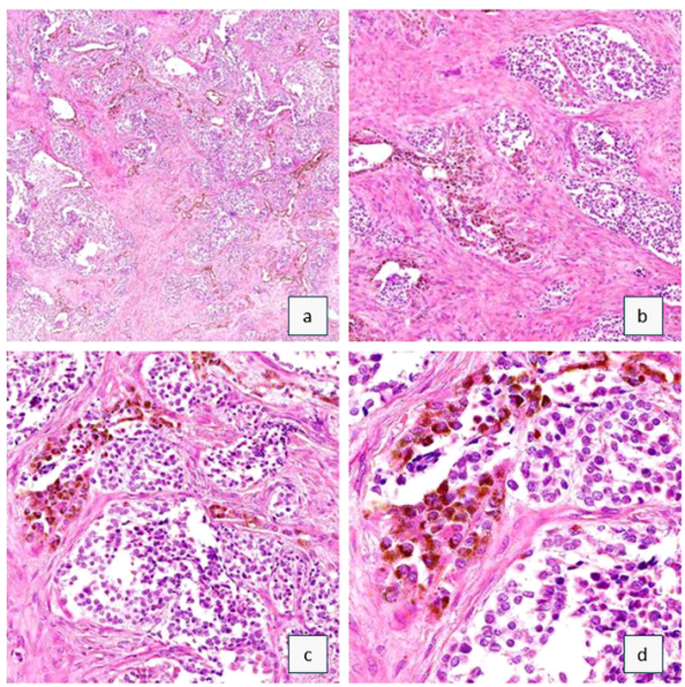 melanotic neuroectodermal tumor of infancy histology Melanotic neuroectodermal tumor of infancy: extra-axial lesion in the  frontal midline of the skull – a case report | Surgical and Experimental  Pathology