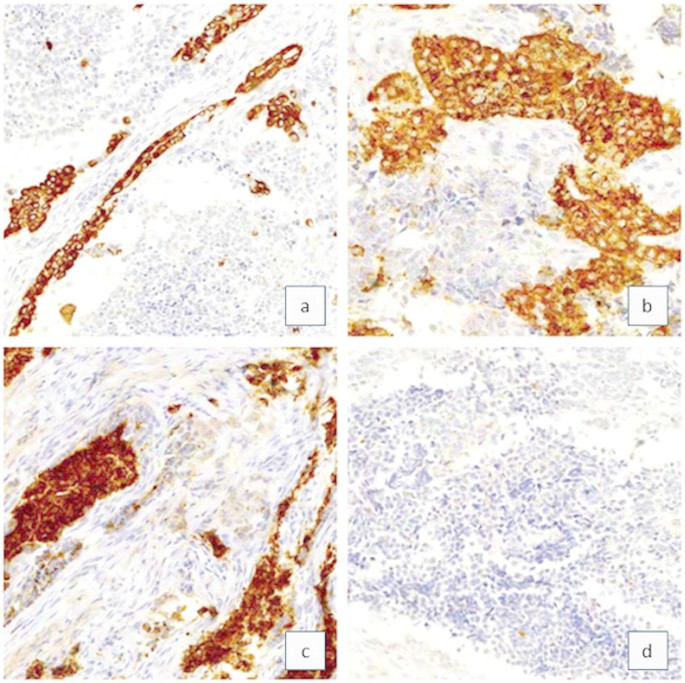 melanotic neuroectodermal tumor of infancy histopathology Com402-1-03.gif Melanotic Neuroectodermal tumor of infancy.