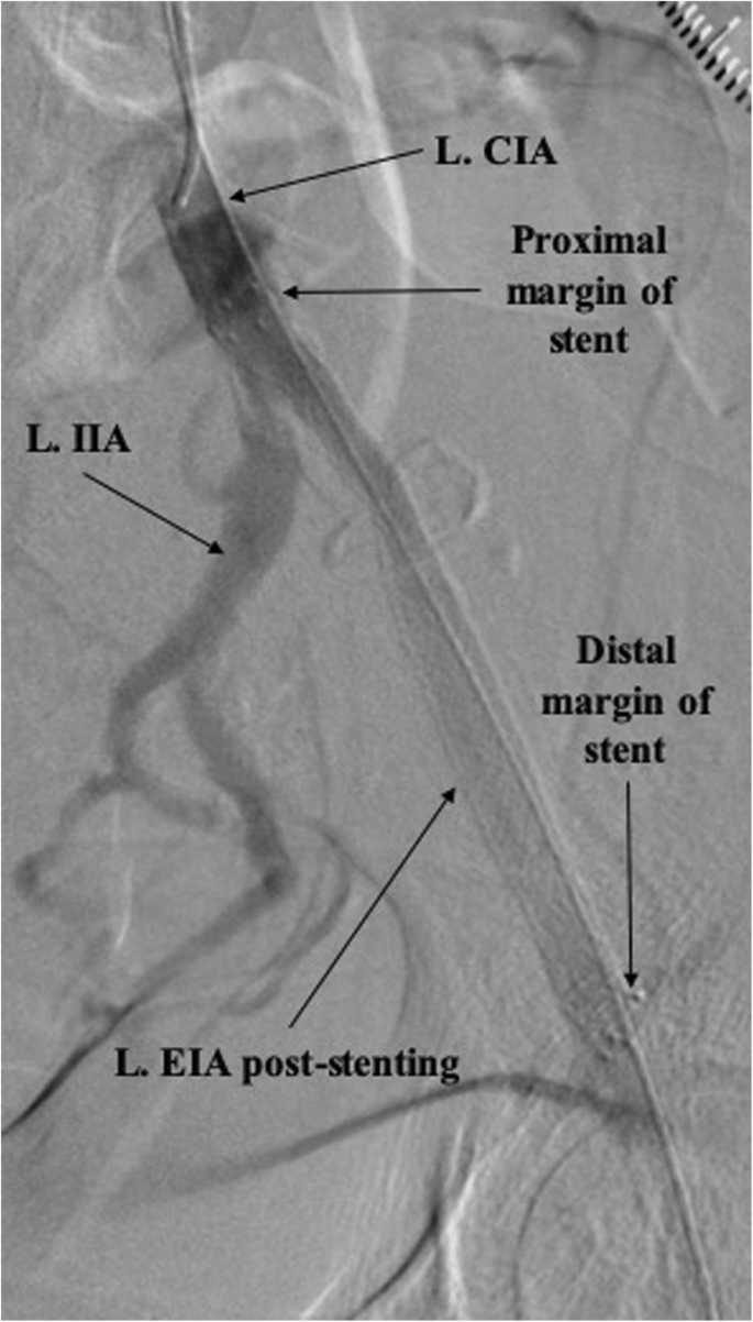 common iliac artery