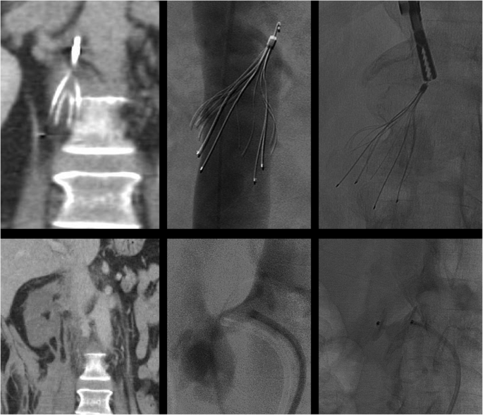 Procedural complications of inferior vena cava filter retrieval, an  illustrated review | CVIR Endovascular | Full Text