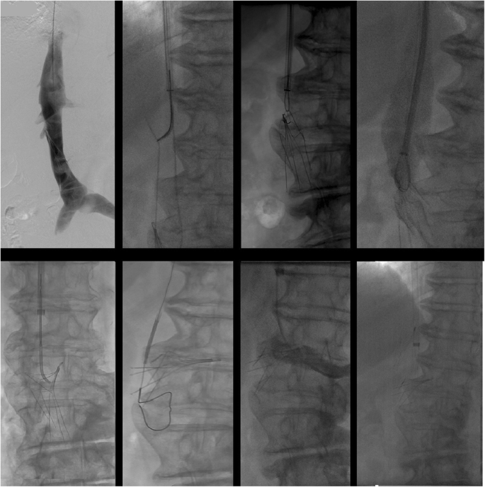 Procedural complications of inferior vena cava filter retrieval, an  illustrated review | CVIR Endovascular | Full Text