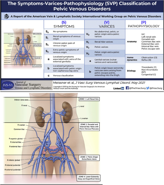 Severe Menstrual Cramps - Vein & Endovascular Medical Care