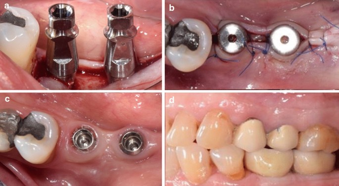 Crestal bone loss around tissue level implants with platform matching  abutments versus bone level implants with conical/platform switched  abutments in the posterior mandible: a comparative study | Bulletin of the  National Research