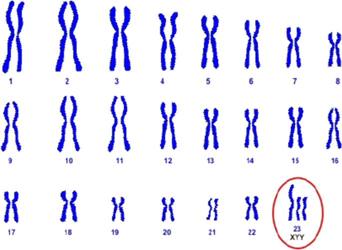 xyy syndrome karyotype