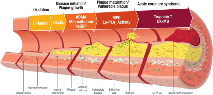 The cellular biology of atherosclerosis with atherosclerotic lesion  classification and biomarkers | Bulletin of the National Research Centre |  Full Text