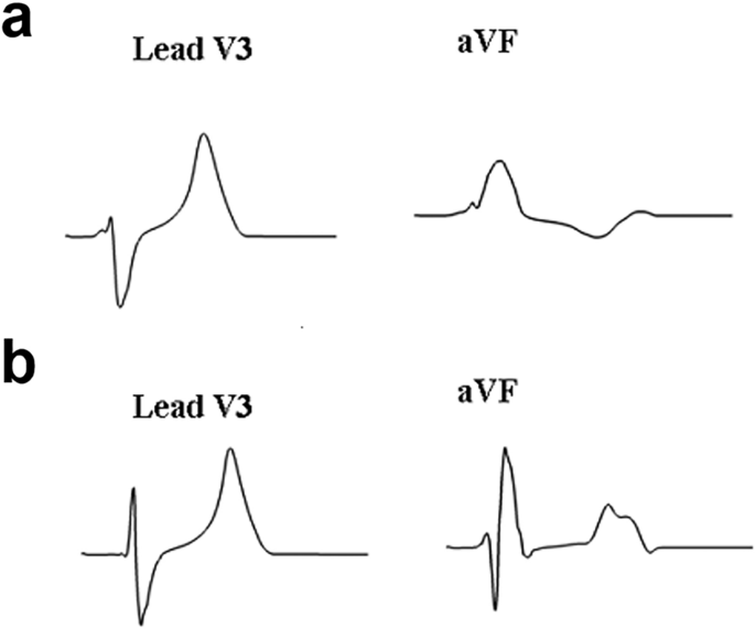 cardiac resynchronization therapy ecg