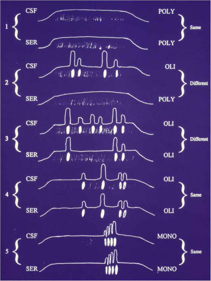 Cerebrospinal fluid lactate level as a diagnostic biomarker for bacterial  meningitis in children, International Journal of Emergency Medicine