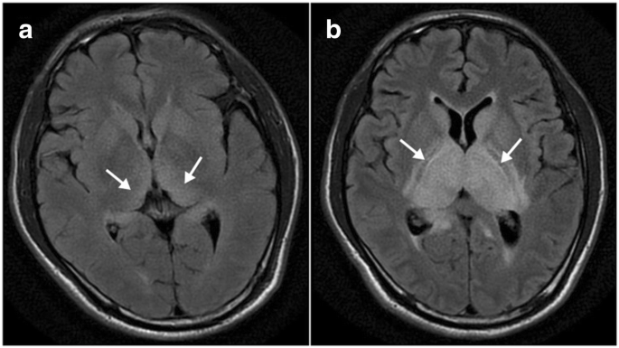 encephalitikus hipertónia)