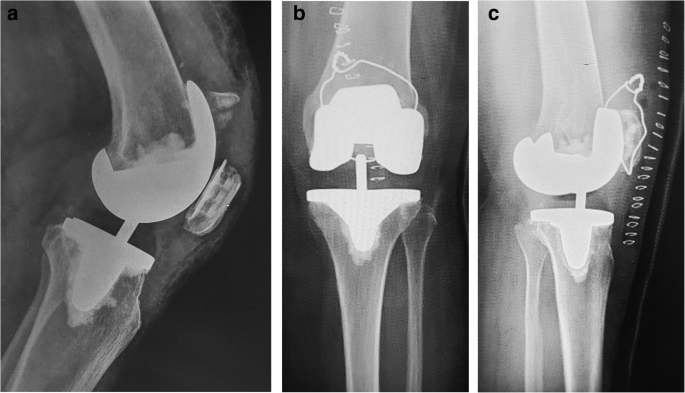 patella hairline fracture