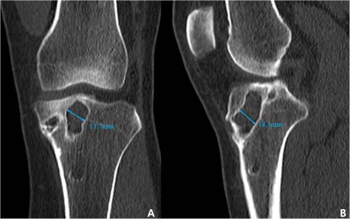 Two Stage Revision Anterior Cruciate Ligament Reconstruction Knee Surgery Related Research Full Text