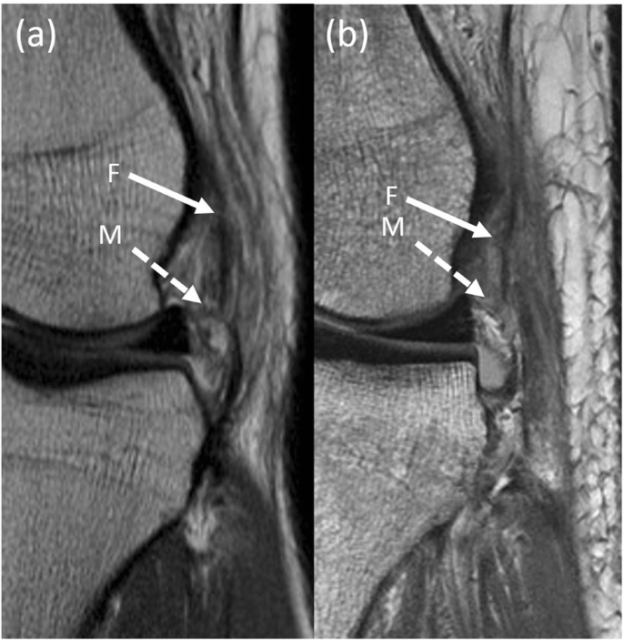 Timing of magnetic resonance imaging affects the accuracy and interobserver  agreement of anterolateral ligament tears detection in anterior cruciate  ligament deficient knees | Knee Surgery & Related Research | Full Text