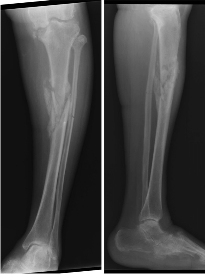 Malunited fracture - tibia, Radiology Case