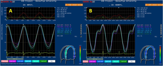 Table 4 from Visual assessment vs. strain imaging for the detection of  critical stenosis of the left anterior descending coronary artery in  patients without a history of myocardial infarction.