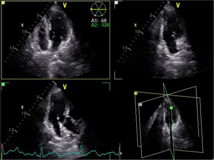 Two-dimensional Echocardiographic Assessment of Myocardial Strain:  Important Echocardiographic Parameter Readily Useful in Clinical Field. -  Abstract - Europe PMC