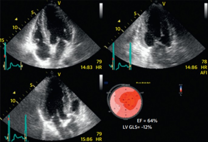 Persistence of abnormal global longitudinal strain in women with peripartum  cardiomyopathy - Bortnick - 2021 - Echocardiography - Wiley Online Library