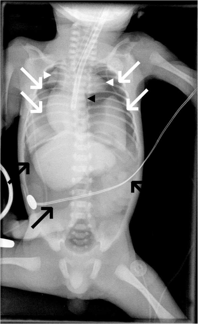 gége papillomatosis pneumothorax