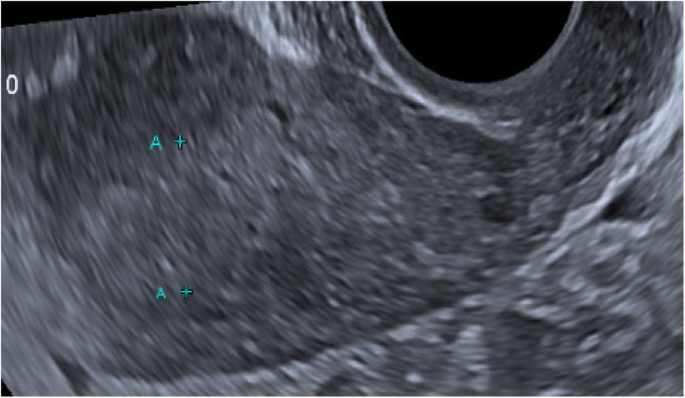 The Uterine Lining And Implantation Of An Embryo Acupuncture Pregnancy Clinic