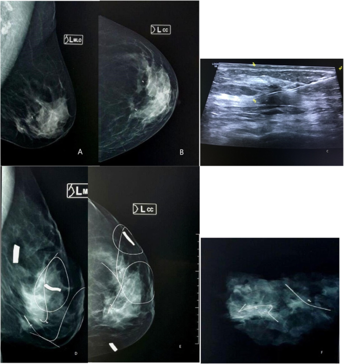 Clip and wire localization of locally advanced malignant breast masses in  patients undergoing neoadjuvant chemotherapy and breast conservation  therapy | Egyptian Journal of Radiology and Nuclear Medicine | Full Text