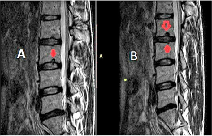 Lumbar spine Schmorl's nodes; prevalence in adults with back pain, and  their relation to vertebral endplate degeneration | Egyptian Journal of  Radiology and Nuclear Medicine | Full Text