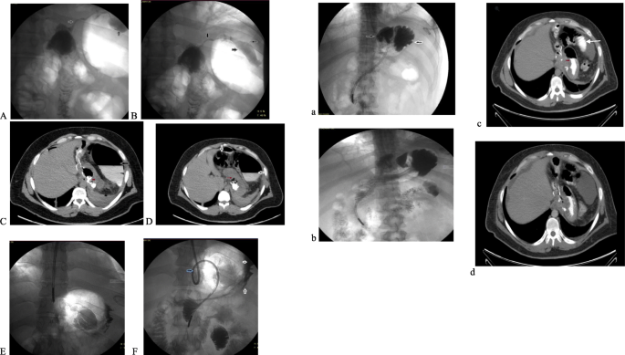 Value Of Contrast Enhanced Multidetector Computed Tomography In Imaging Of Symptomatic Patients After Laparoscopic Roux En Y Gastric Bypass And Laparoscopic Sleeve Gastrectomy Egyptian Journal Of Radiology And Nuclear Medicine Full Text